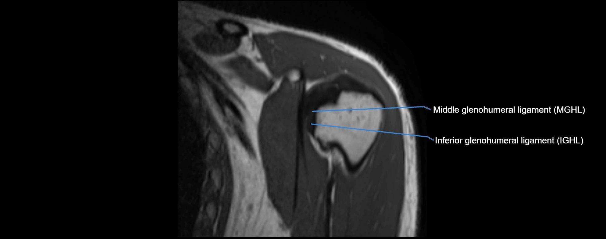 shoulder ligments coronal  cross sectional anatomy 3T MRI AI enhanced radiology image -img-00001-00008.webp